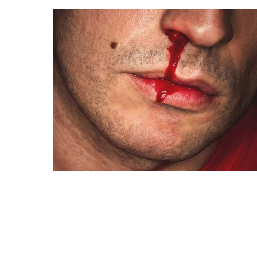 NasalCease First Aid for Cuts & Nosebleeds