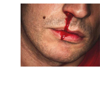 Thumbnail for NasalCease First Aid for Cuts & Nosebleeds