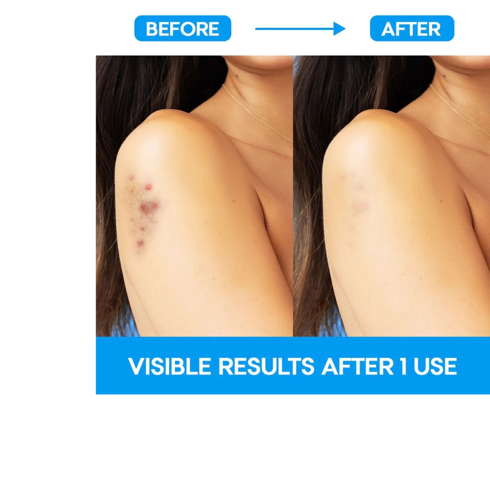 EZAcne Pimple Patches – Body