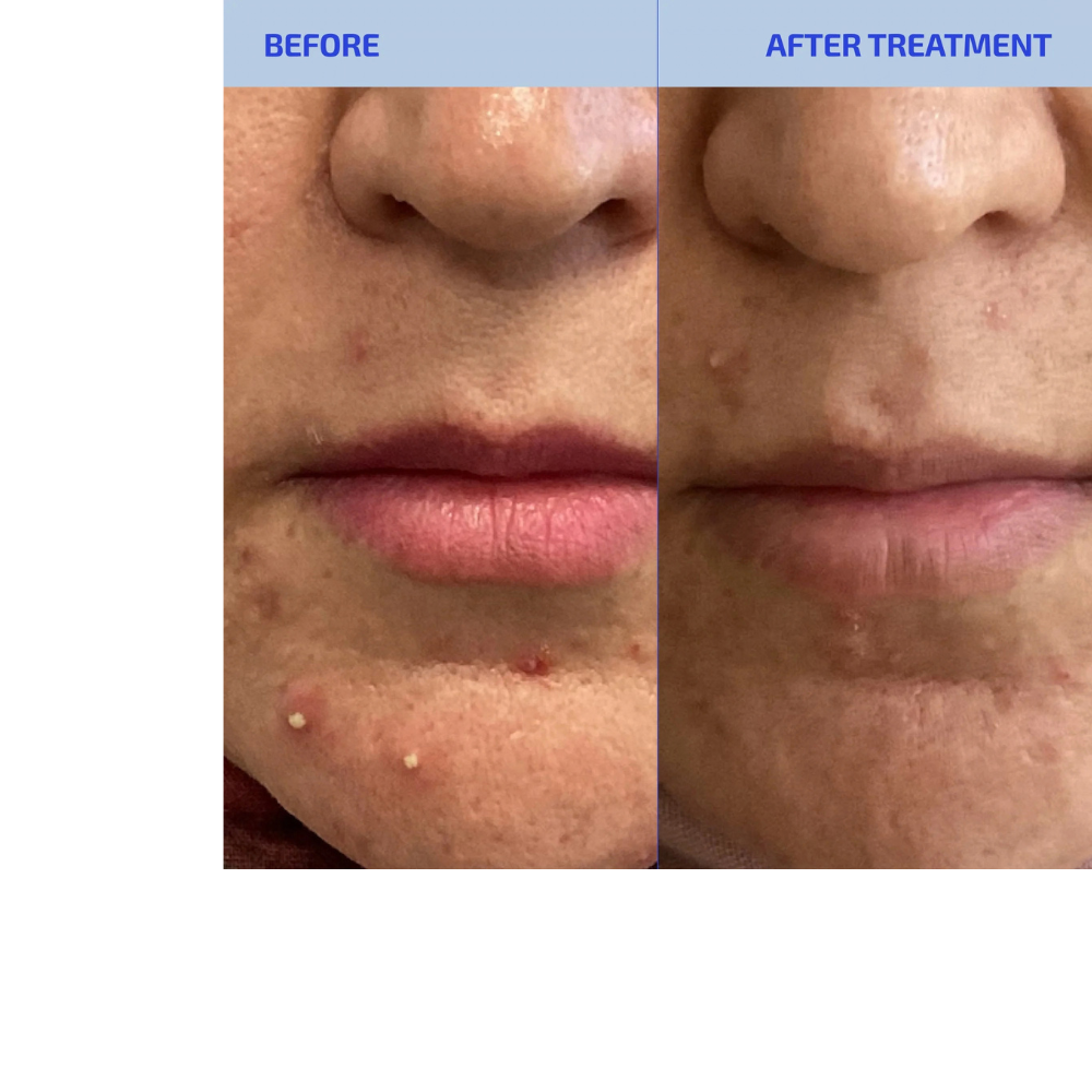 SHAANT Skin De-Stress Supplement 2.0 for Hormonal Acne
