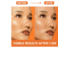 Thumbnail for EZAcne Pimple Patches – Nose